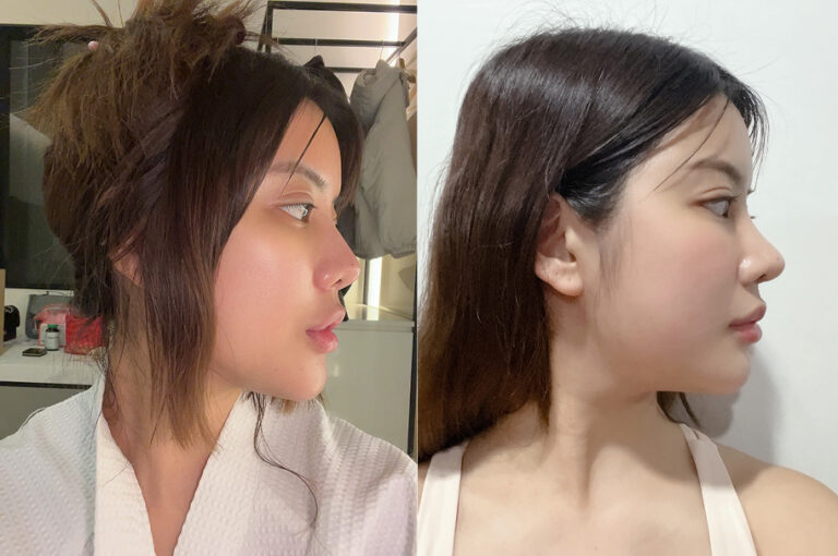 Soda’s Real Review | Follow my 3-months journey after revision rhinoplasty
